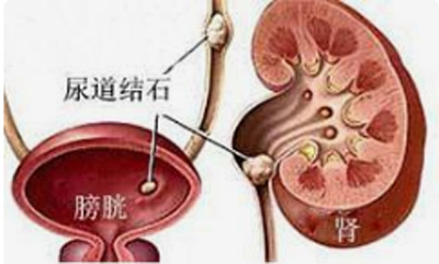 尿路结石食疗方