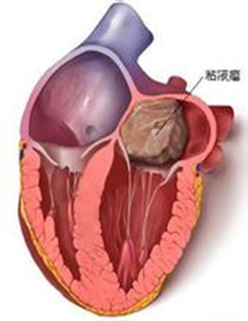 治疗粘液瘤秘方