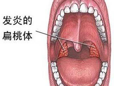 扁桃体发炎特效方！