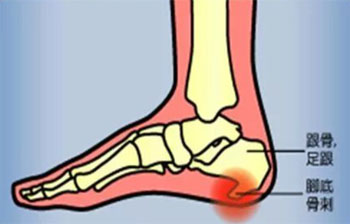 外治跟骨骨刺一绝