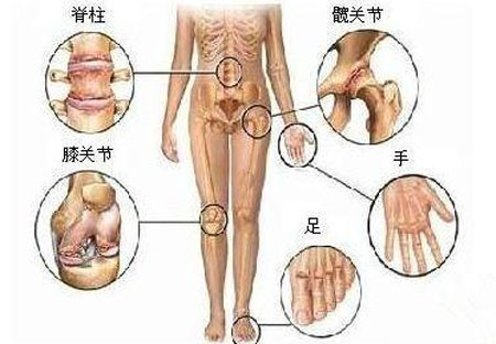 治疗‘关节炎’家传效方