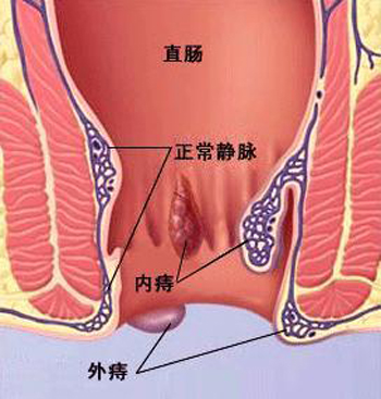 化痔丸治疗内外痔