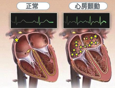 中医“房颤”辩证治疗