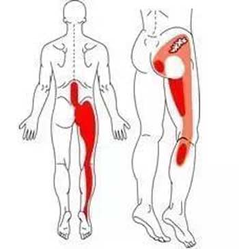 治疗顽固的坐骨神经痛专方