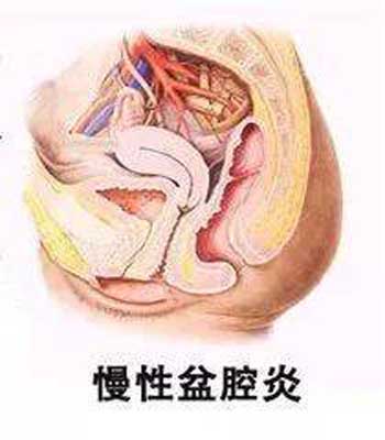 慢性盆腔炎宜散瘀破结