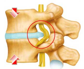 腰椎间盘突出
