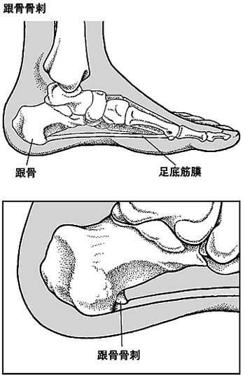 消鱼刺的方法竟能治疗骨质增生