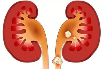 治肾结石、膀胱结石的秘方