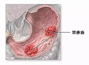 自拟活胃散治大面积胃溃疡