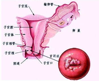 宫颈癌内治、外治系列六方