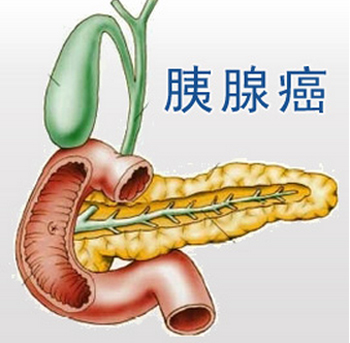 中医治疗胰腺癌病案