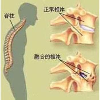 强直性脊柱炎的中医诊治验案