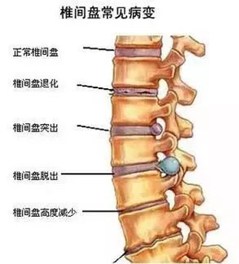 腰椎间盘突出症的五个特效秘方