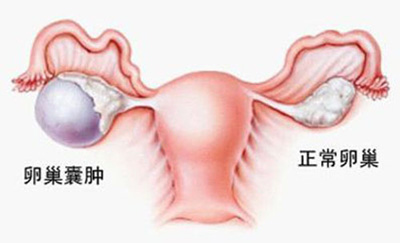 中医药治愈卵巢囊肿