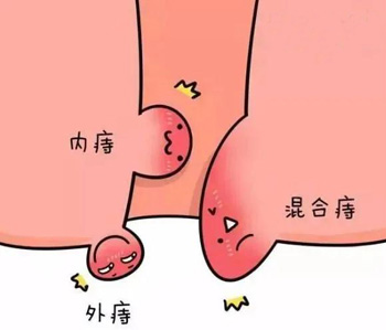 民间中医最全痔疮偏方