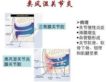 类风湿性关节炎的内外调理