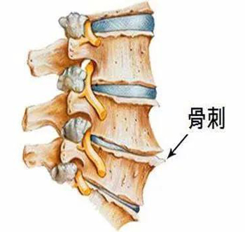 骨刺