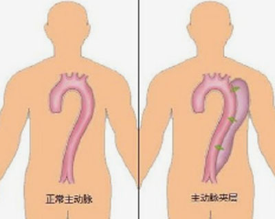 主动脉夹层撕裂