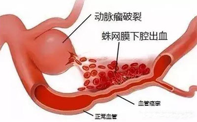 蛛网膜下腔出血