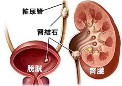 肾结石