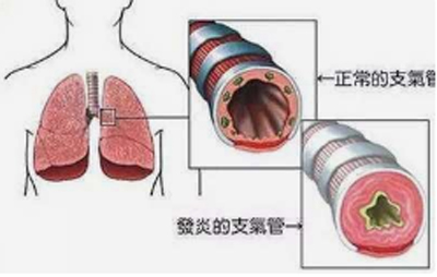 慢性支气管炎