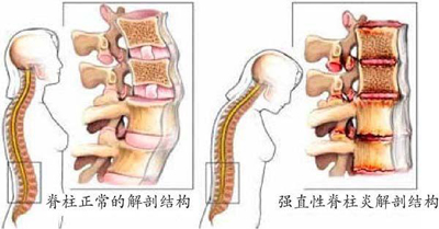 强直性脊柱炎