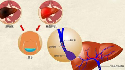 肝硬化腹水