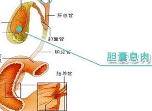 胆囊息肉