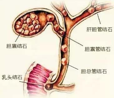 胆结石