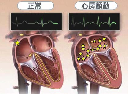 风湿性心脏病