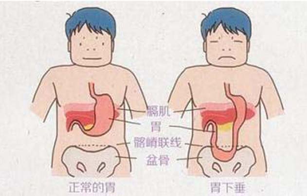 治疗胃下垂的实效验方