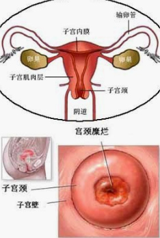 中药外治宫颈糜烂