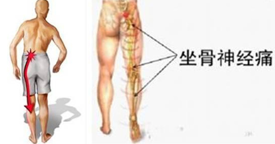 坐骨神经痛验方