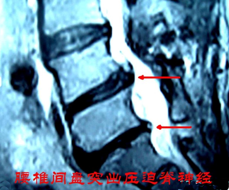 治疗“腰椎间盘突出症”偏方