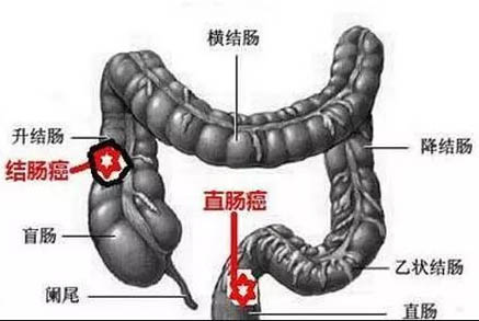 直肠癌偏方