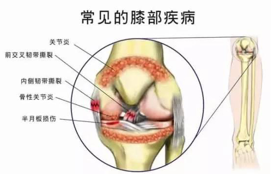 四神煎治疗膝关节积液