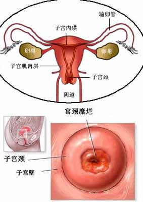 蜂蜜纱布方治疗宫颈糜烂