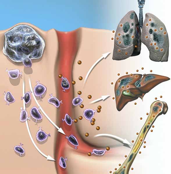癌细胞扩散、转移 www.zgmjyxw.com